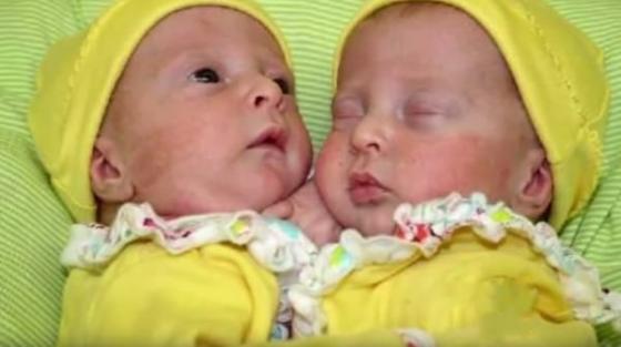 Miracle_Identical_Conjoined_Tw_F_3043018698